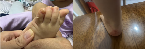 千元童鞋把脚穿肿？泰兰尼斯遭家长“围攻	”，医生警惕影响发育，90%专利竟是外观设计  第3张